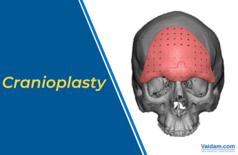 What is Cranioplasty: Preparation, Procedure, and Recovery