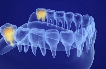 Tooth Crown Cost in India