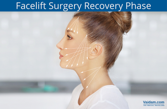 Facelift Recovery Phase