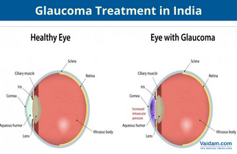 Glaucoma Treatment in India: Symptoms and Cost
