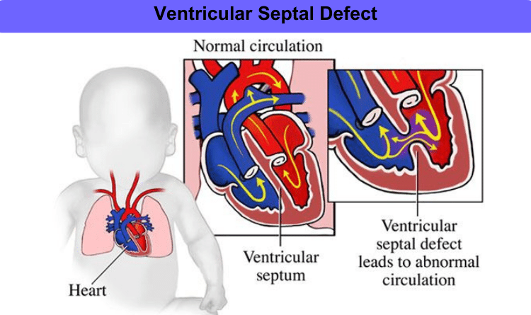 Understanding Ventricular Septal Defect (VSD) Treatment in India ...