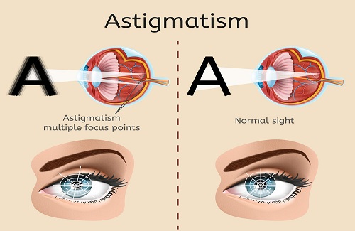 astigmatism 