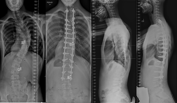 Xray image of before and after spinal fusion