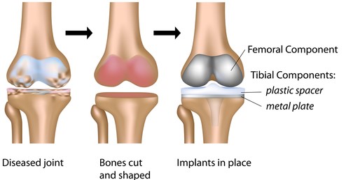 Components of Knee Transplant