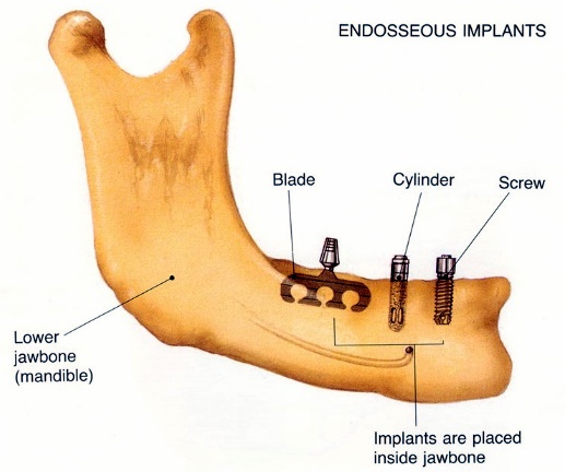 Endosseous Implants