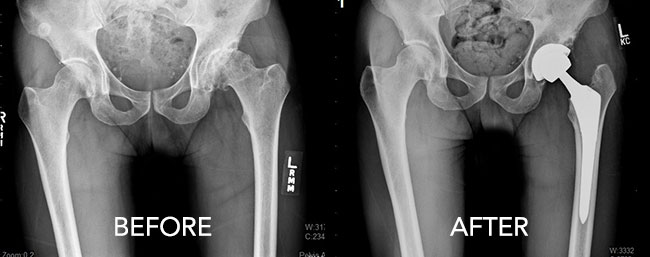 Hip Replacement Recovery