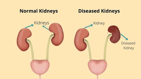Kidney disorders 