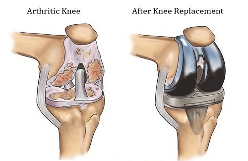 knee replacement surgery in Turkey - Vaidam Health