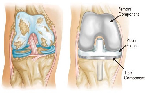 knee replacement surgery in india
