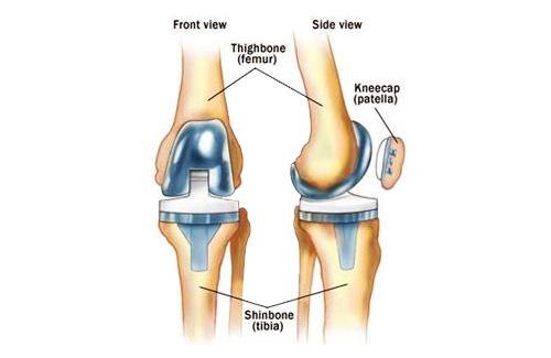 kneecap replacement