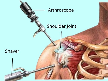 Procedure of Shoulder Replacement