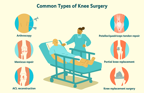 Types of knee replacement surgery in Turkey - Vaidam