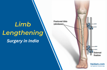 Limb Lengthening Surgery in India: How Does it Work?