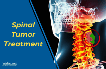 Spinal Tumors: Understanding the Symptoms and Treatment