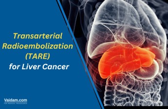 TARE for Liver Cancer: Transforming Lives and Futures